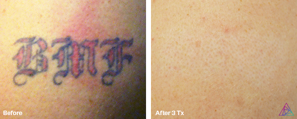 Before and after tattoo removal